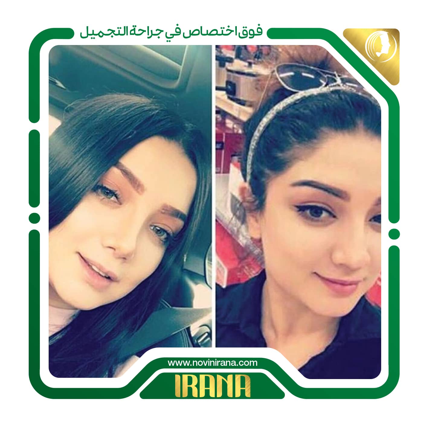 تجميل الانف
