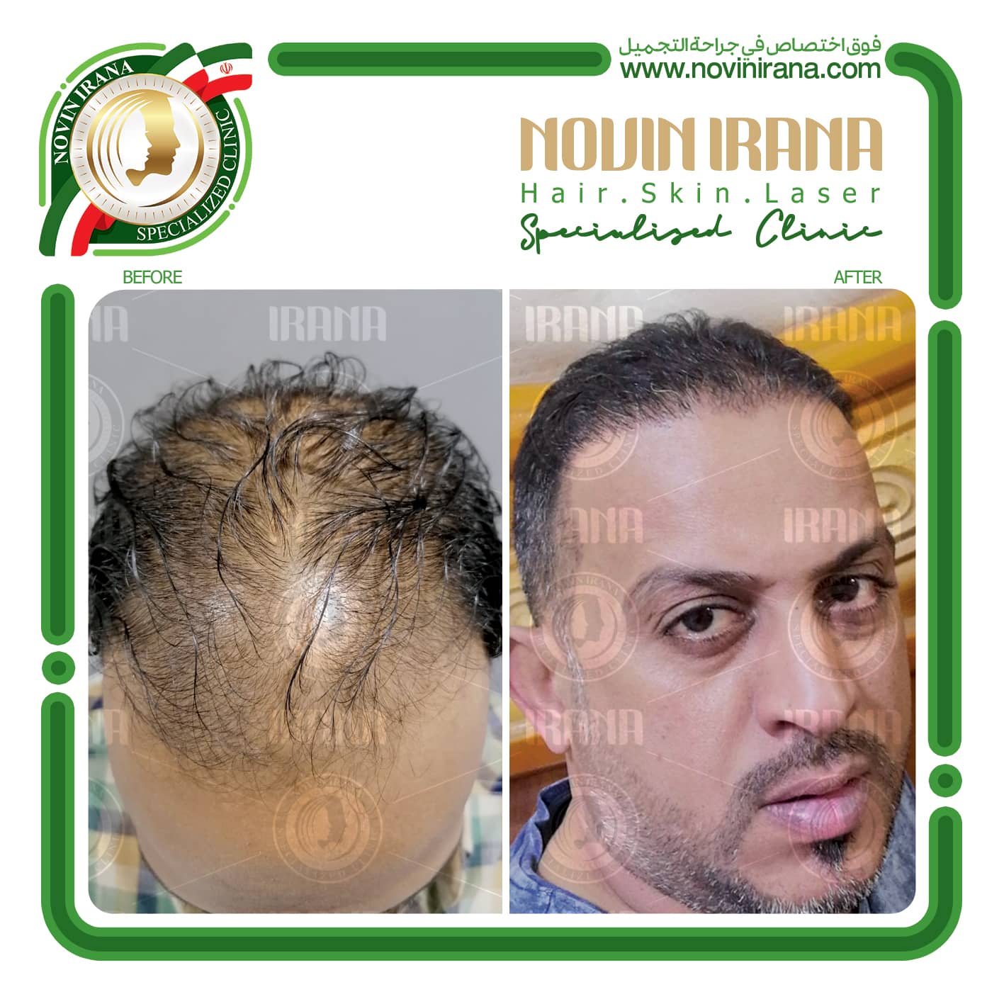 زراعة الشعر