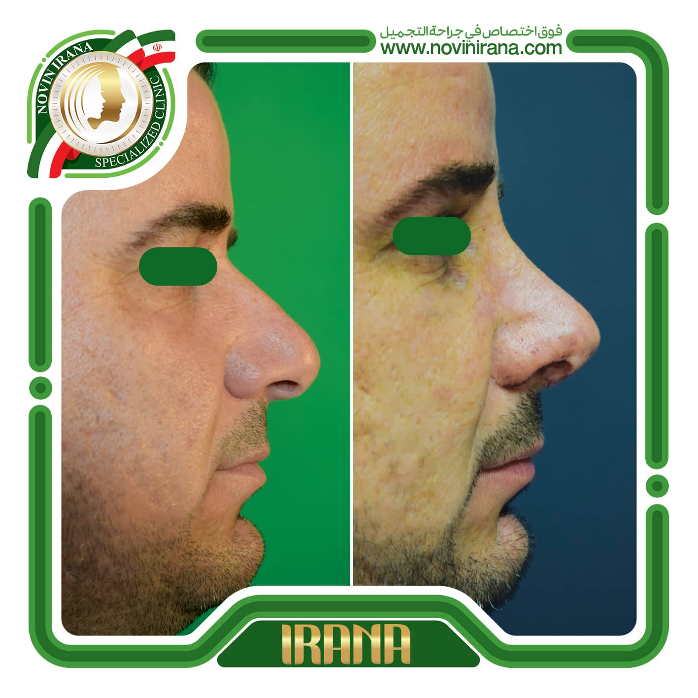 تجميل الانف