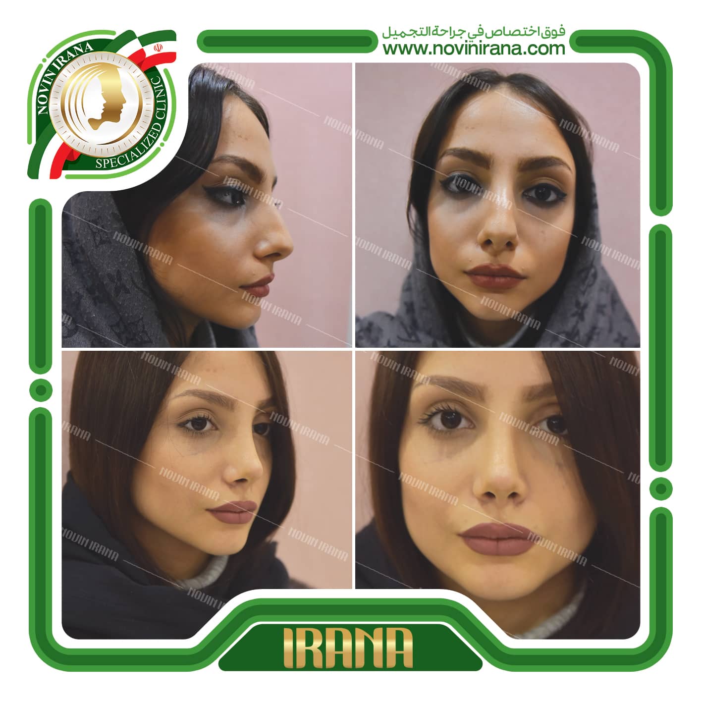 تجميل الانف